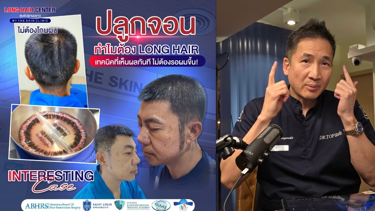 ปลูกหนวดเครา 3D Long Hair FUI ที่โรงพยาบาลปลูกผม Dr.Top Hair Hospital