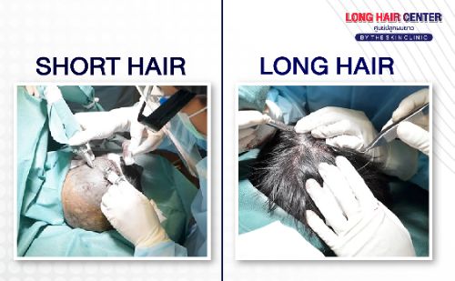 ปลูกผม FUI “เทคนิคผสมผสานร่วมกับการฉีดไขมันกระตุ้นรากผม ALMI Nanofat for Hair Loss”